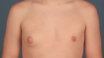 male breast growth